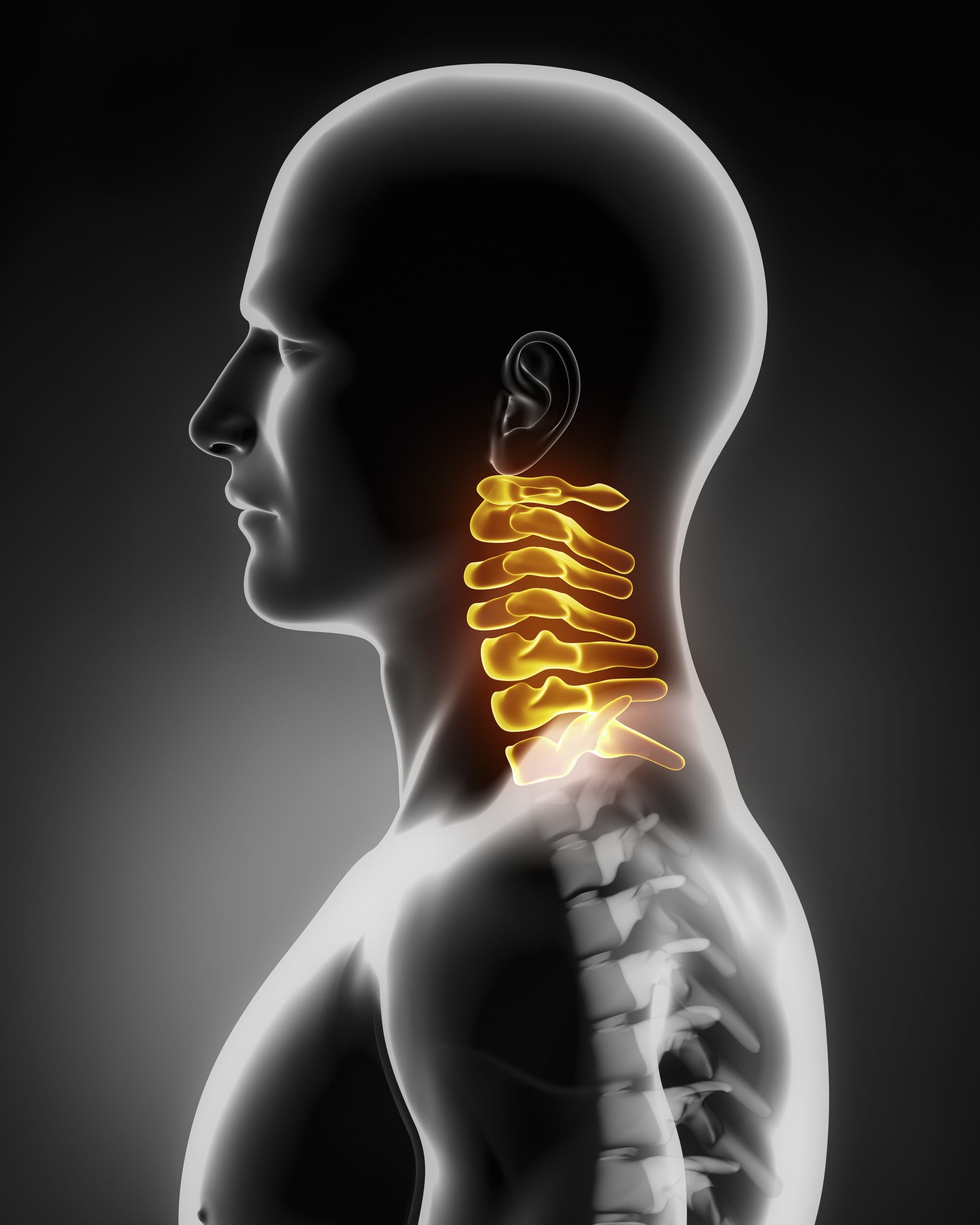 Things To Avoid With Cervical Spinal Stenosis